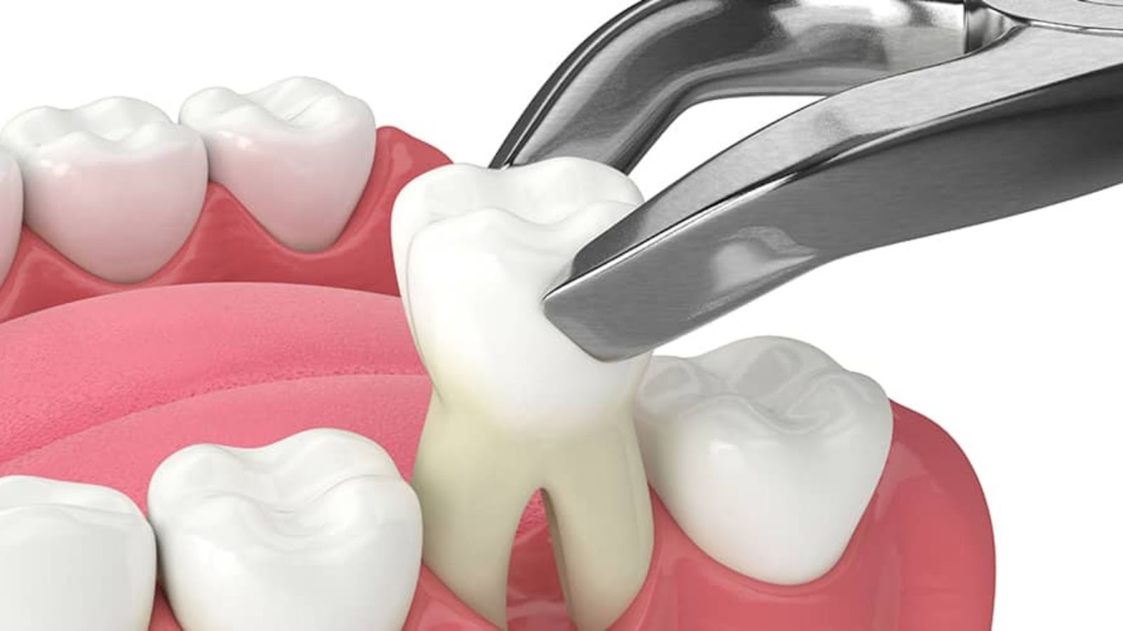 How To Recognize The Signs Of A Healing Molar Extraction Site Breaking AC how-to-recognize-the-signs-of-a-healing-molar-extraction-site-breaking-ac